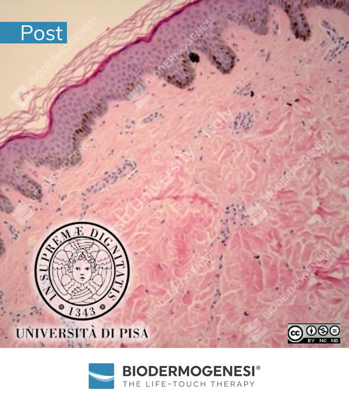 Biodermogenesi Biopsy