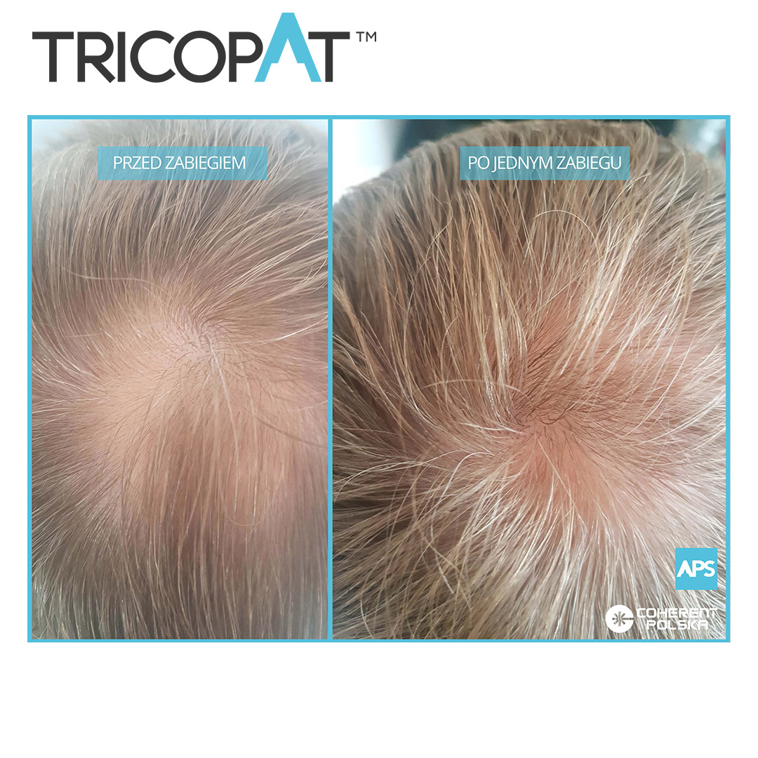 Tricopat Hair Growth Treatment