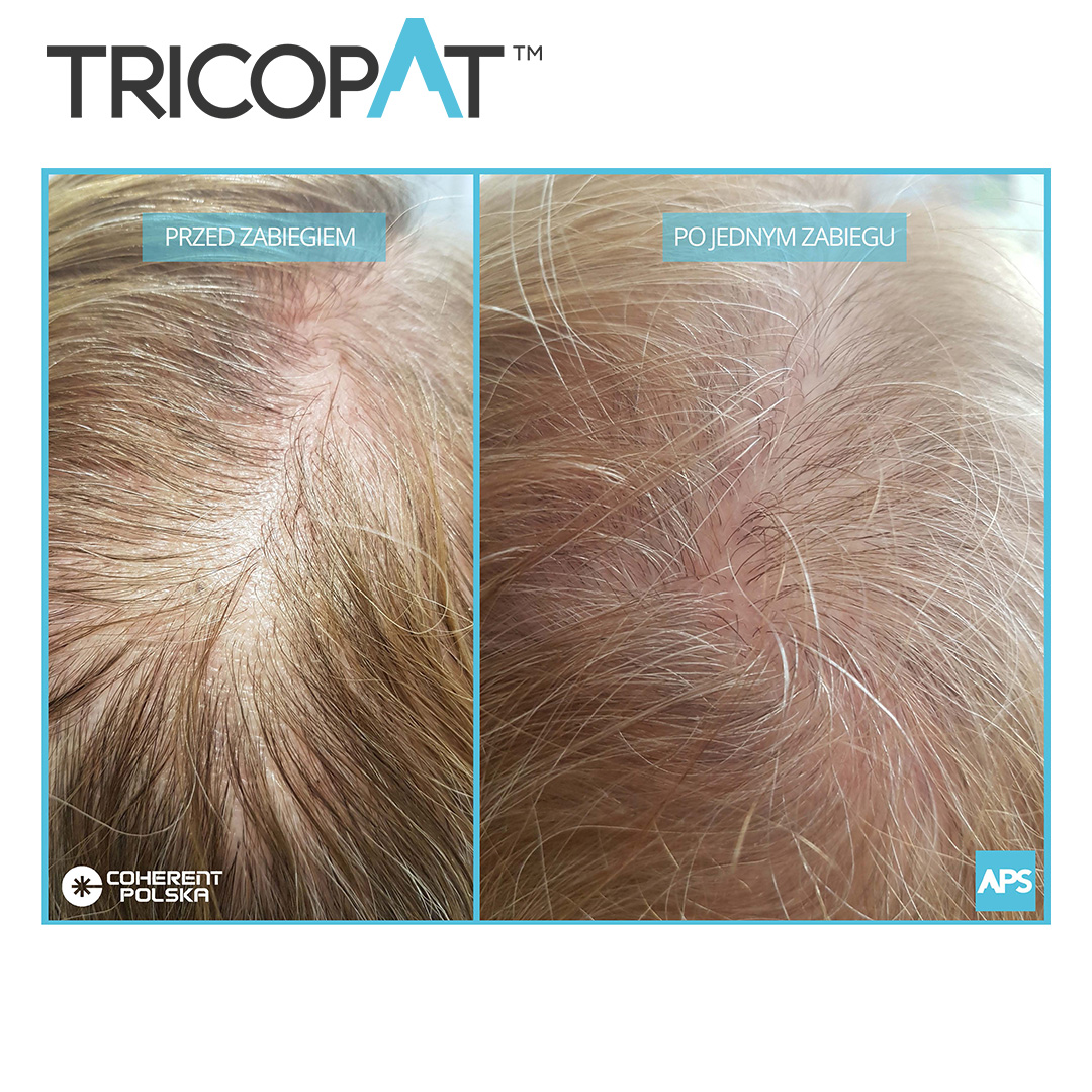 Tricopat Solution for Hair Loss