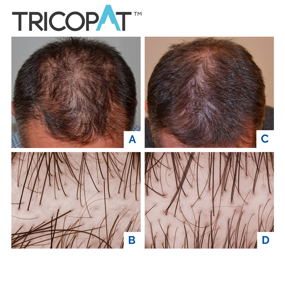 Hair restoration with Tricopat