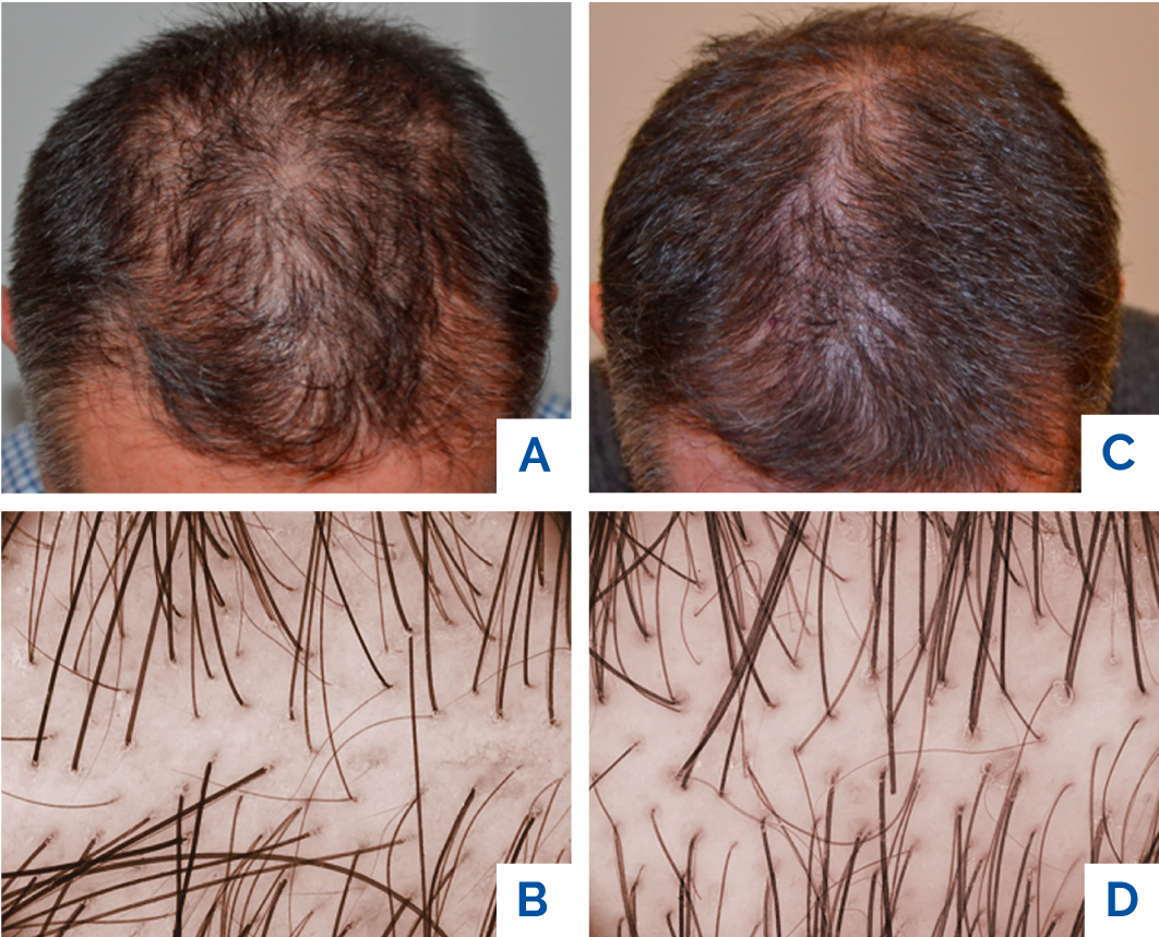 Tricopat hair restoration