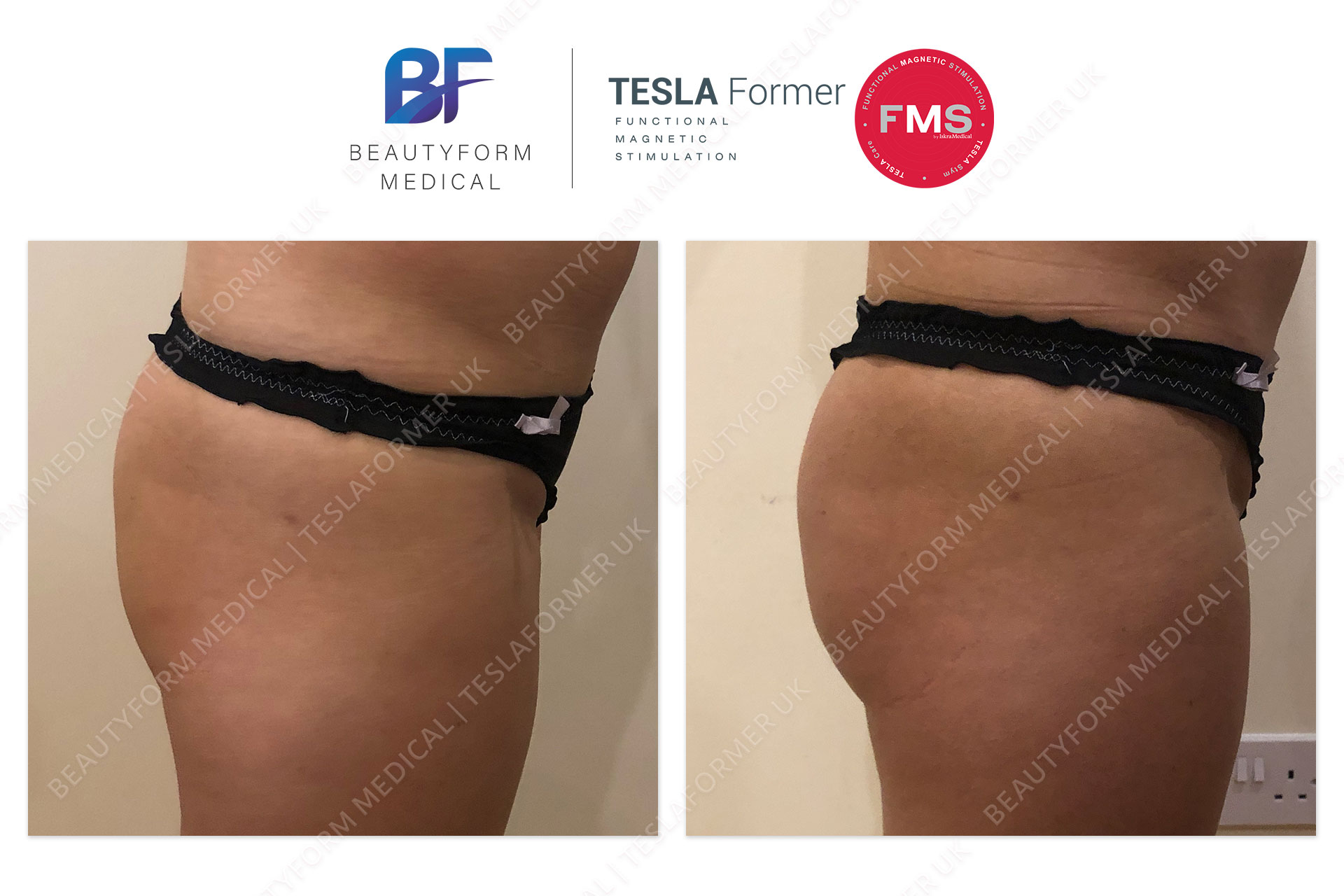 Tesla Former buttocks before and after