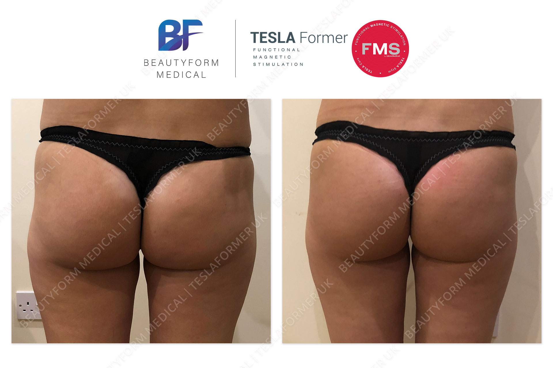 Tesla Former buttocks before and after photo