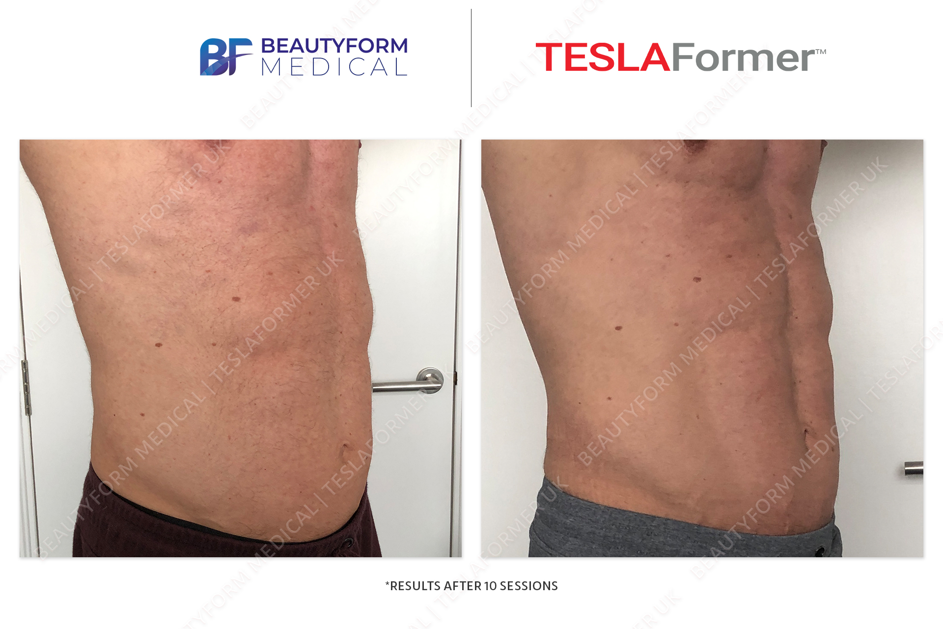 Tesla Former Before and After abs