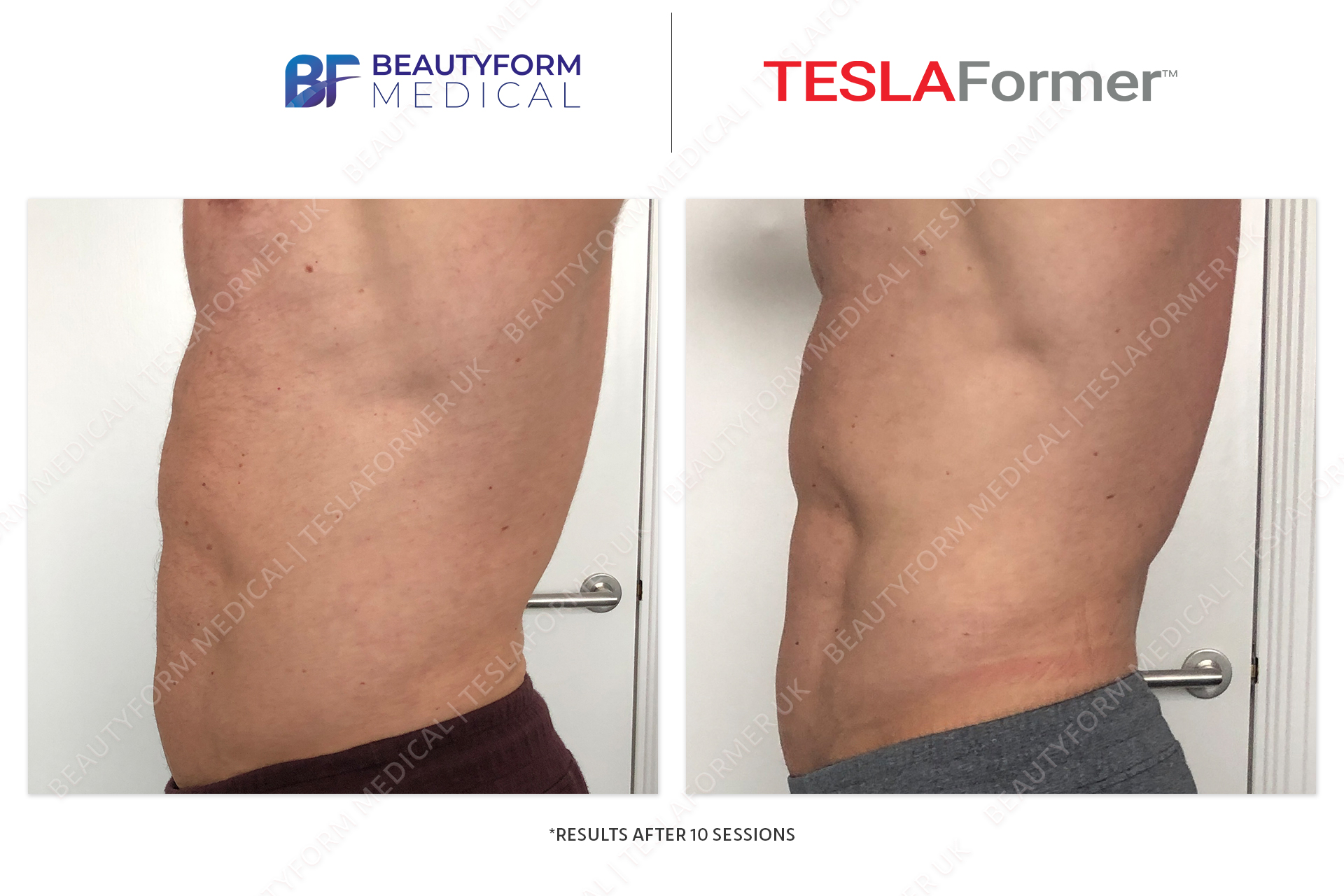 Tesla Former Before and After abs