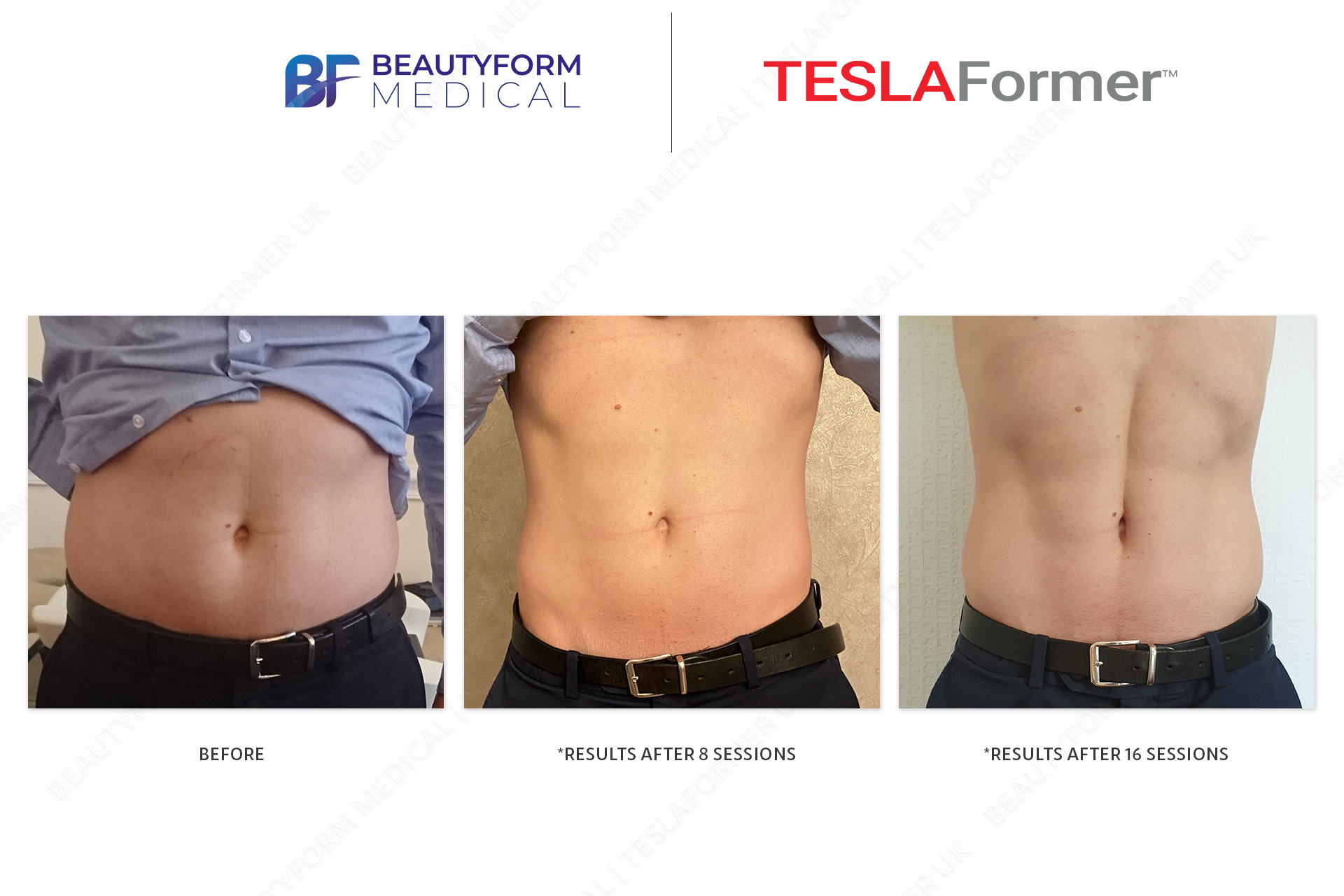 Rectus abdominis muscle results before and after Tesla Former