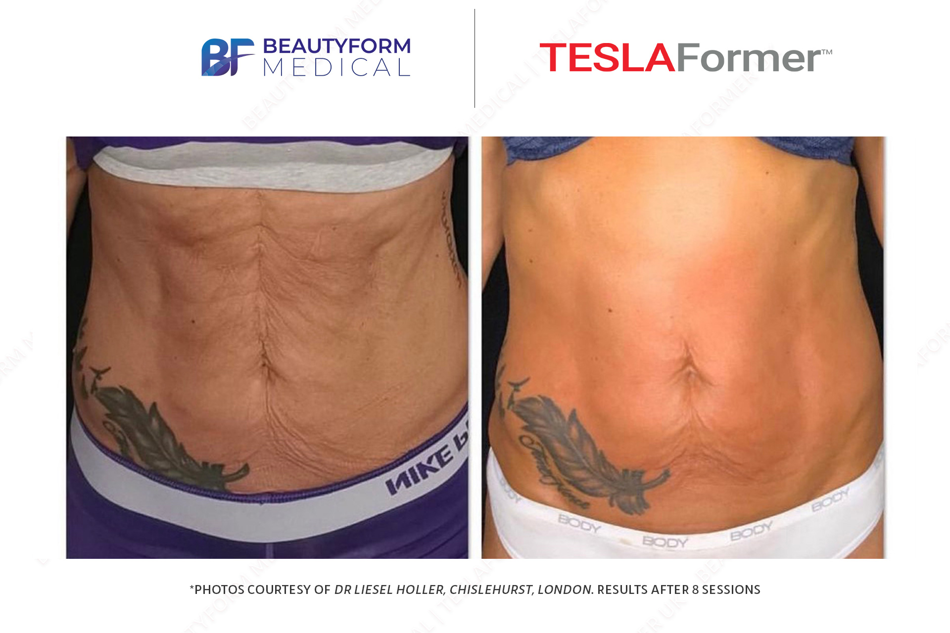 Tesla Former Dr Liesel Holler Abdominal Before and after photos